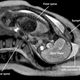 Illustration for article titled First Ever MRI Video Shows Childbirth from the Inside